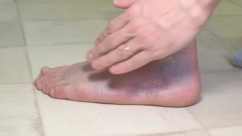 A man applies a medicinal ointment to a sprained leg. Stock Footage 230279341