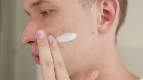 Man applying medicated cream to acne blemishes on his cheek. Skin care trea.. Video stock 339569950