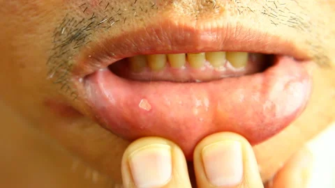 Man is applying oral paste to mouth sore, in studio Chiangmai  Thailand. Stock Footage 164080658