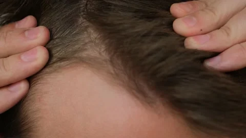 A man with a bald patch on his head checking the condition of his hair, close-up Stock Footage 221047548
