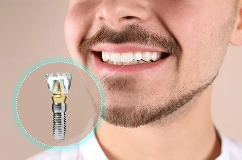 Man with beautiful smile after dental implant installation procedure on bei.. Stock Photos