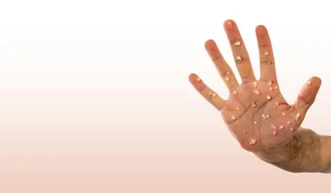 Man with blisters on his hands from monkeypox. blank background. Stock Photos