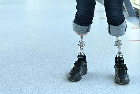 A man with bone-implanted leg prostheses. osteointegration Stock Photos