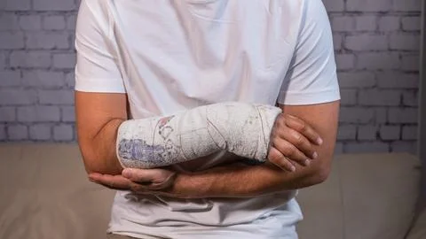 Man with broken arm, distal radius fracture Stock Photos