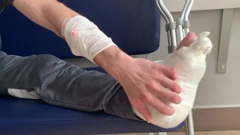 Man with a broken leg is being treated in hospital. Stock Footage 306079197
