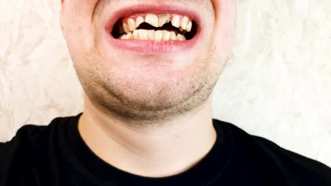 Man with broken teeth, dental trauma. Damaged teeth in the mouth. Stock Footage 279855232