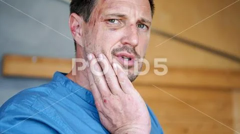 A man bruised and hurt after a fight Stock Photos