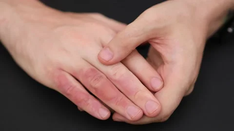 Man with burn on her hand, closeup. Burn blister on the hand. Hand male with Stock Footage 205544224