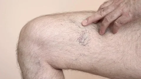 Man checking his veins and capelliars Stock Footage 93597219