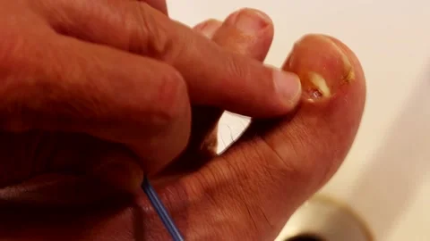 Man checking for Toe Nail Fugus Video stock 219641954