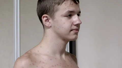 Man with Chickenpox Stock Footage 293176505
