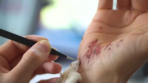 Man cleaning a bleeding wound under the skin after the accident. Treatment and Stock Footage 133239513