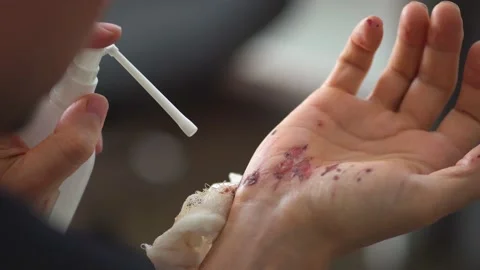 Man cleaning a bleeding wound under the skin after the accident. Treatment and Stock Footage 133240043