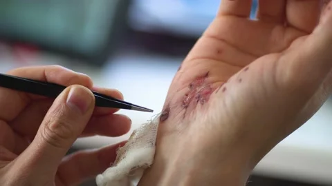Man cleaning a bleeding wound under the skin after the accident. Treatment and Stock Footage 133997766