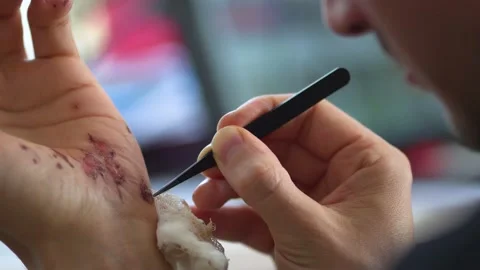 Man cleaning a bleeding wound under the skin after the accident. Treatment and Stock Footage 135152924
