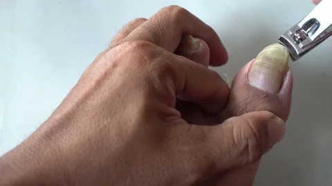 A man cut the dirty, long toe nail with clipper Видео 167752931