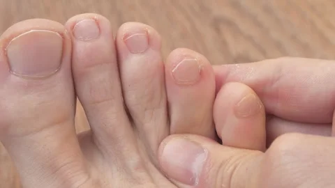 Man cuts toe nail using a metal nail clipper. Foot and toes of an adult man Video stock 318251255
