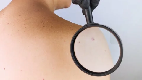 A man at a dermatologist appointment shows his birthmarks, moles and nevi. The d Video stock 158165809