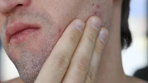 A man with a dissatisfied face runs his hand over the peeling skin of his face. Stock Footage 297361548