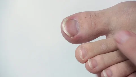 A man does a pedicure on the toe. Something went wrong, and the nail pushed up n Stock Footage 99728870