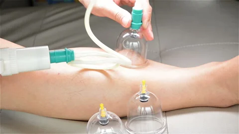 Man doing cupping therapy on his leg Stock Footage 94329731