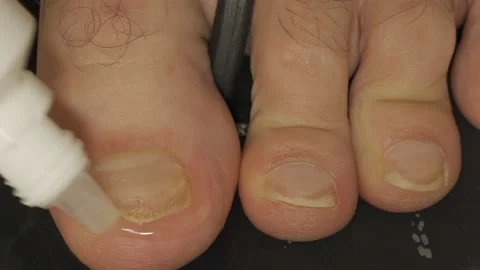 A man is dripping drops on toenails infected with fungus in close-up shot. Stock Footage 233112403