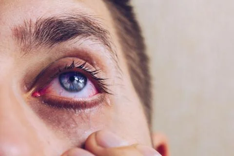 A man drips open human eye with bright red arteries drops to improve vision c Stock Photos