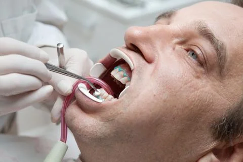 Man during teeth whitening process Stock Photos