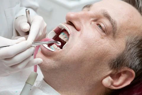 Man during teeth whitening process Foto stock