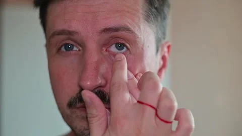 A man examines his eye to study the effects of Chalazion, a condition causing 库存影片 337558493