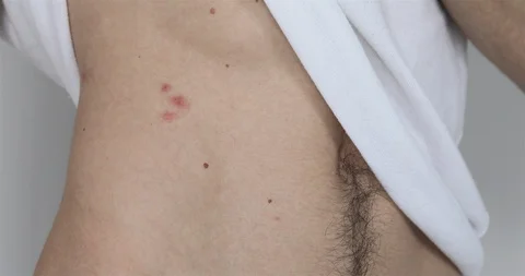 Man Examining  Red Spots On The Side. Stock Footage 123703882