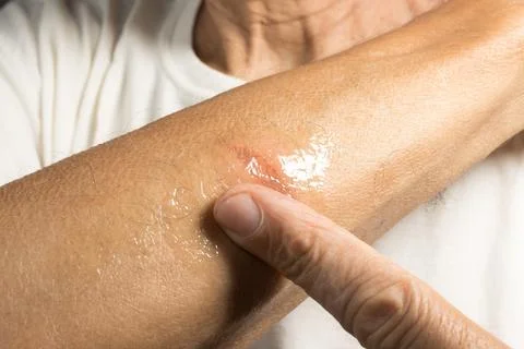 Man with a first degree burn on his forearm Stock Photos