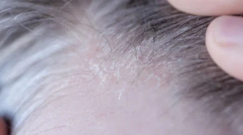 Man with flaking scalp Stock Footage 33895591