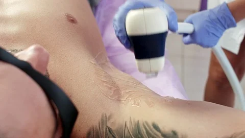 Man getting permanent laser armpit hair removal Stock Footage 78507495