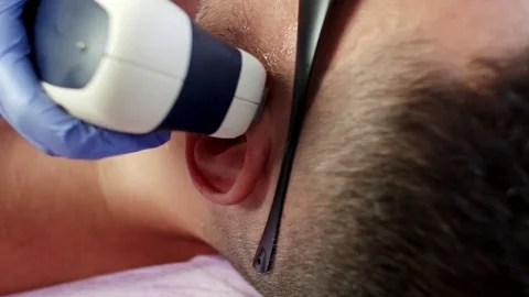 Man getting permanent laser face hair removal Video stock 78507483