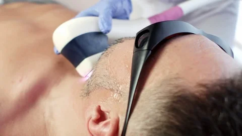 Man getting permanent laser face hair removal Stock Footage 78507484