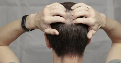 Man with hair loss problems close-up. Stock Footage 146288942