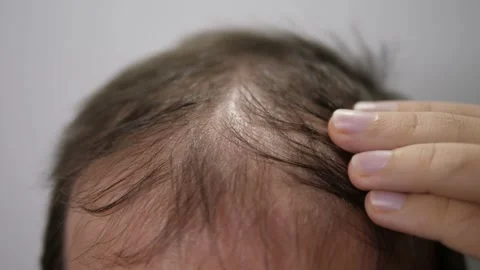 Man with hair loss problems close up Stock Footage 169769817
