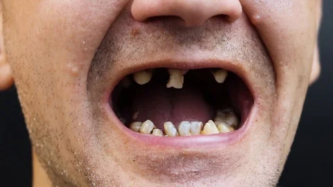 The man has rotten teeth, teeth fell out, yellow and black teeth hurt. Poor teet Stock Footage 113692367