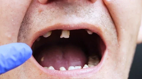 The man has rotten teeth, teeth fell out, yellow and black teeth hurt. Poor teet Stock Footage 113692403
