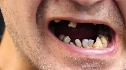 The man has rotten teeth, teeth fell out, yellow and black teeth hurt. Poor teet Video stock 113692474