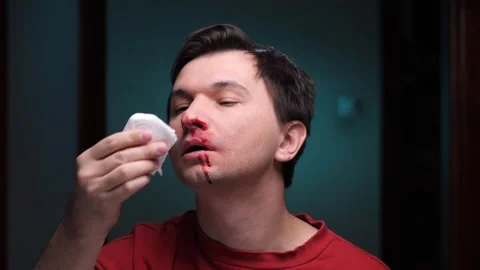 Man is holding tissue to bleeding nose and suffering from nosebleed Stock Footage 306801671