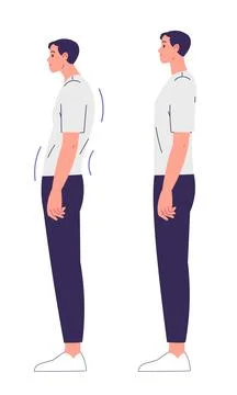 Man with impaired posture and correct posture. Spinal curvature, scoliosis Illustrazione stock