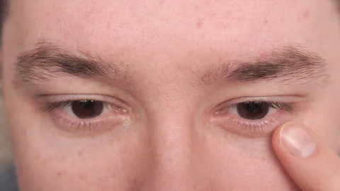 Man instilling eye drops while lying Stock Footage 103497633