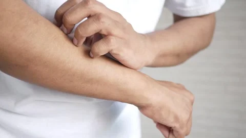 Man itching his arm, close-up dynamic footage of skin irritation and discom.. Stock Footage 333031201