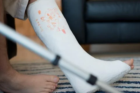 Man with a leg plaster Stock Photos