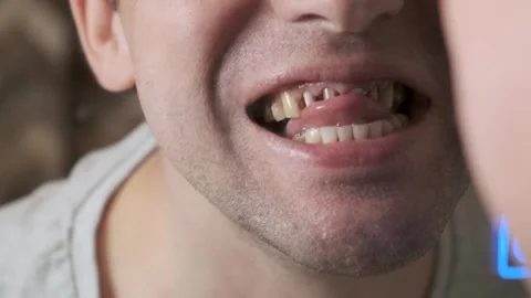 Man looking in the mirror on his bad diseased teeth affected by caries and Stock Footage 261734872