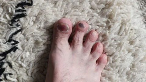 A man looks at his nails, blue from injury. Video stock 244877947