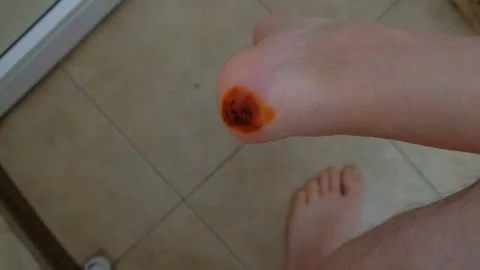 Man man treating a wound on his leg 스톡 동영상 296108793