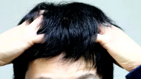 A man massaging his scalp Stock Footage 336222172